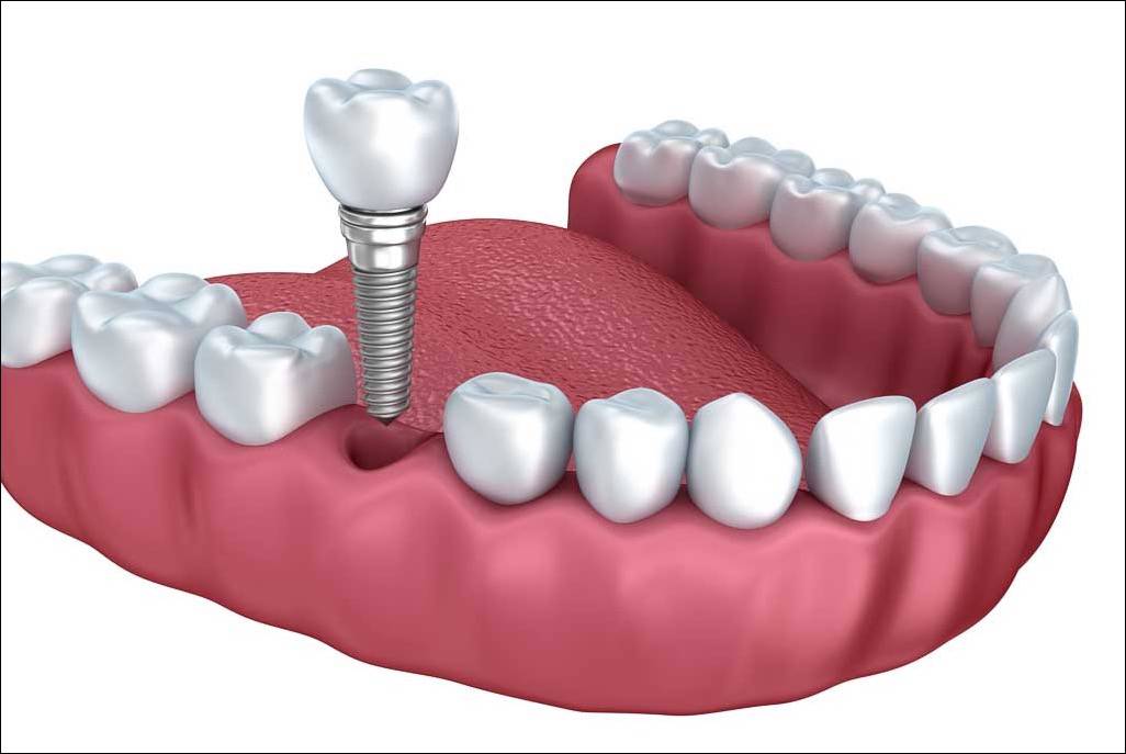 dental implant placement