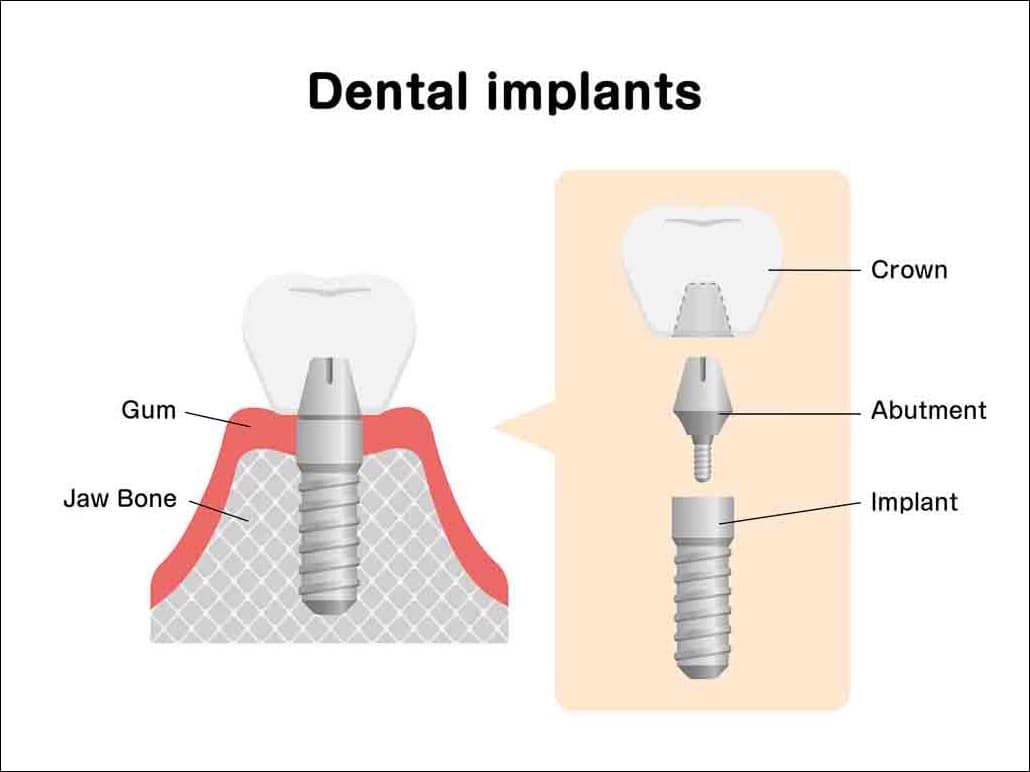 dental implant parts